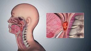 Throat Cancer Kills Fast, Avoid This Three Things To Save Your Life