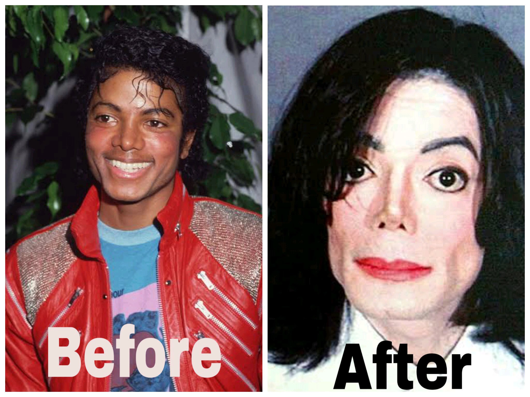 Micheal Jackson Didn’t Change His Skin On Purpose, He Had A Skin Disorder Called Vitiligo