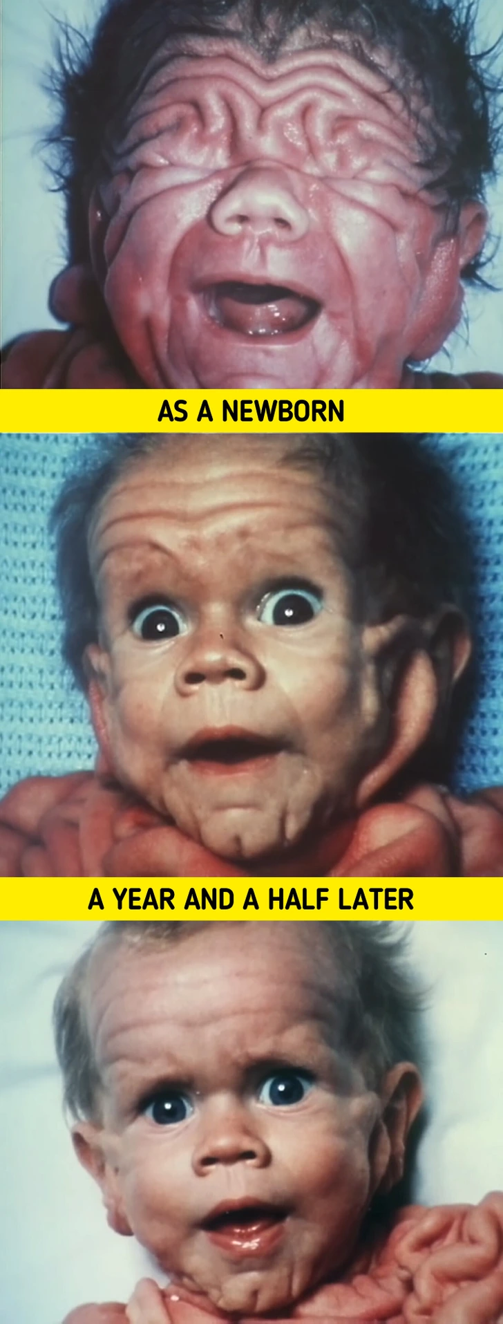 The Story of the Baby Who Challenged Doctors With His Rare Disorder for 20 Years