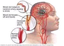 If You Don’t Want To Suffer Stroke At Old Age, Avoid Excess Intake Of These 3 Things