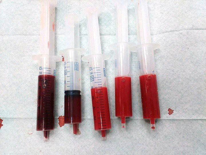 What To Know About HIV And Blood Type-O