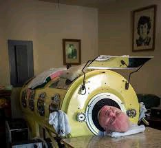 Tragic Loss: Polio Survivor Man In Iron Lung Passes Away At 78