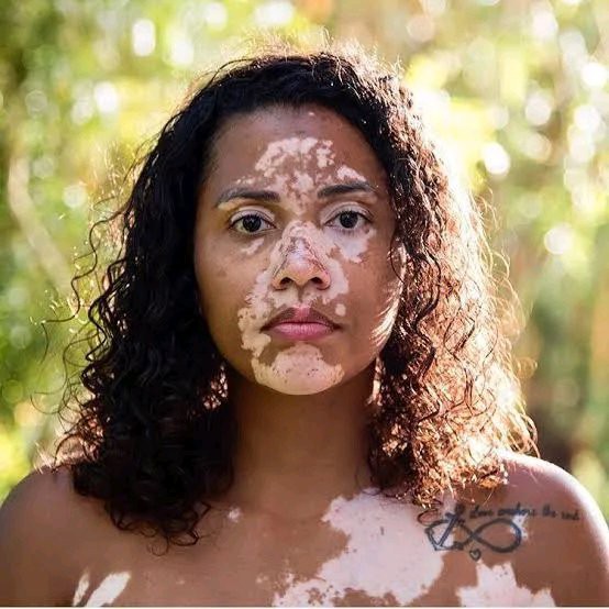 Why You Might Develop The Skin Condition Called Vitiligo