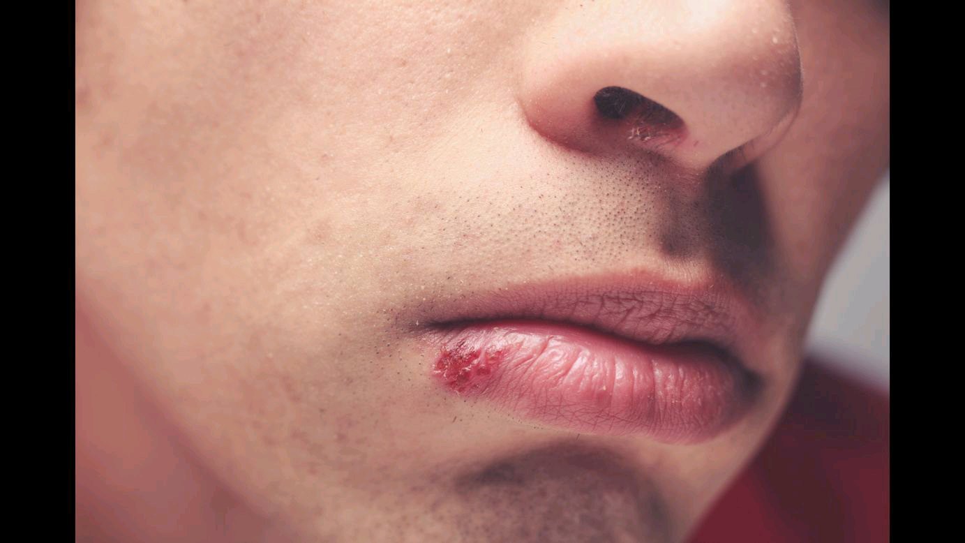 Kissing Could Bring You These 8 Deadly Diseases